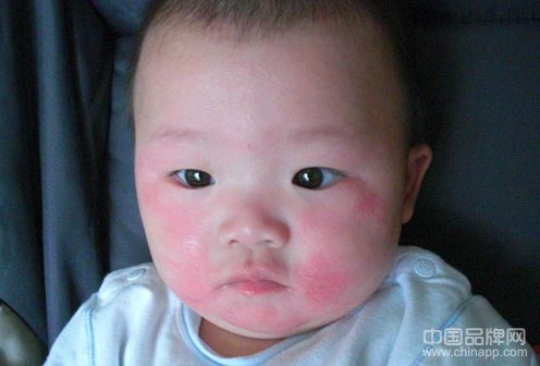 宝宝反复湿疹是怎么回事
