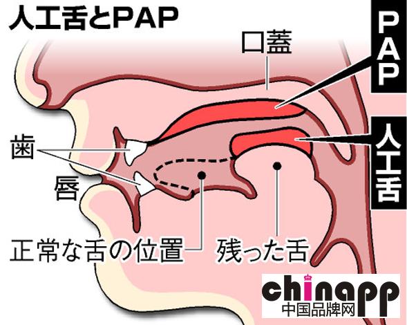 日本研发人工舌头 帮助患者恢复语言功能2