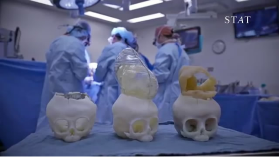 3D打印立功！这个头骨模型挽救了婴儿的生命1